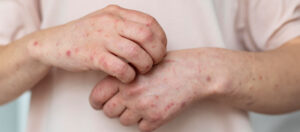 Aumentam os casos de mpox no mundo: entenda
